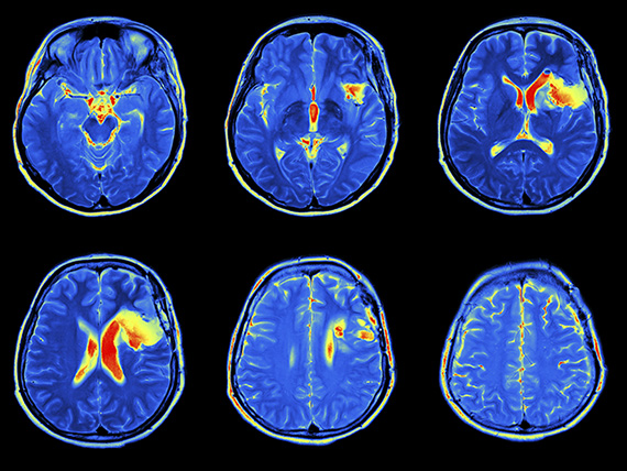 MRI scan image of brain