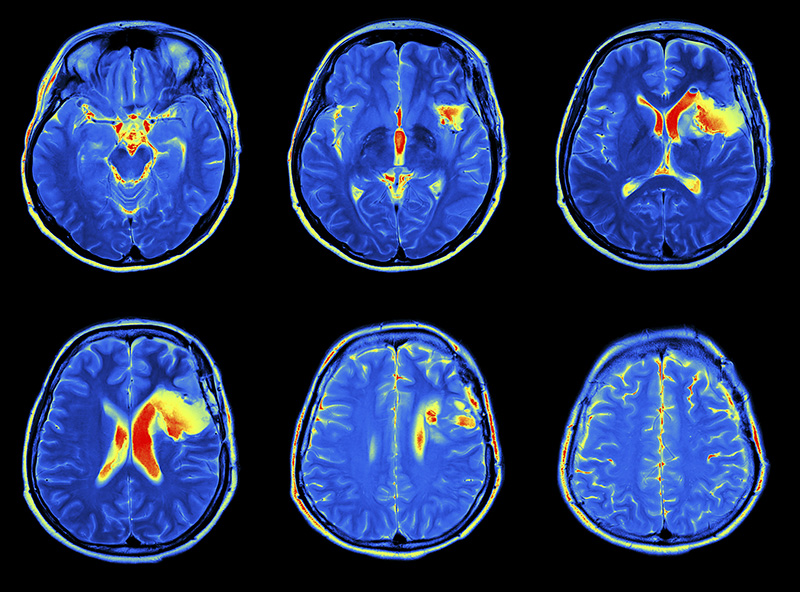 Brain Awareness Night: MRI scan image of brain